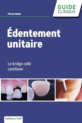 Edentement unitaire : Le bridge collé cantilever