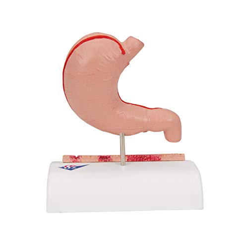 Image of 3B Scientific K17 Stomach w / Ulcers - 3B Smart Anatomy