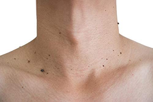 Wart Remover cream 5ml | Massa Remover Cream | Skin Tag Remover Cream | Mole Remover Cream (Pack of -1)