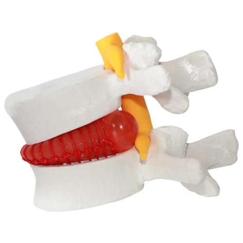 Modèle de hernie discale en PVC 1,5X pour démonstration médicale