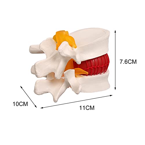 Modèle de hernie discale 1:1 articulé pour une visualisation claire - 4