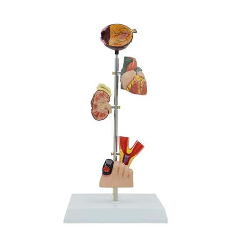 Modèle d'anatomie du vaisseau sanguin rénal humain avec pathologies