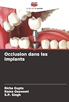 Occlusion dans les implants (French Edition) 6208934648 Book Cover