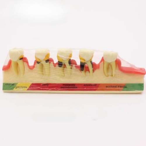 超高酷似度で多様なデザインの口腔教学用歯モデル:矯正、インプラント、病理など多くの症例シーンをカバーし、着脱可能な義歯、備洞、連結ブリッジなどを含み、歯科全シーンのデモンストレーションに適しています (歯周病変モデル)