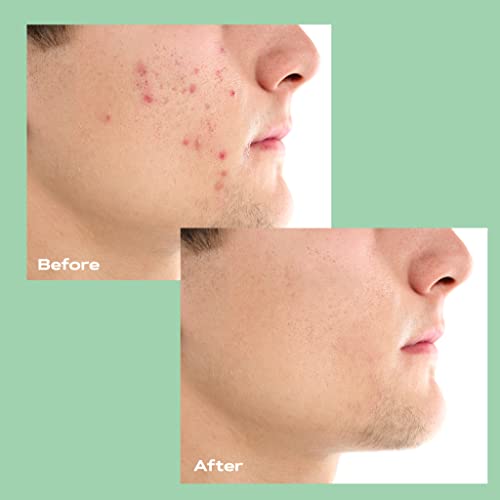 Kamedis Acne Treatment Kit, Clinically Proven 3-Step Acne Clearing Solution, Salicylic Acid with Proven Botanicals Acne Treatment System