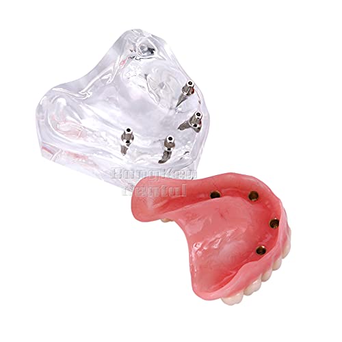 Teeth Model Demo Dental 2 3 4 Implant Implants Bridge Overdenture Typodont Restoration Study Teach Demo Superior Upper (M6001C)