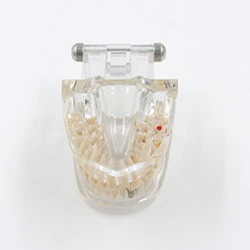 Modèle de dents transparent avec implants amovibles pour cabinet dentaire et étude - 6
