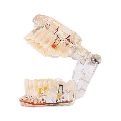 Image of iDENTical Patient Education Model (Caries, Implant, Nerves) M2001-3 | 3D Model | Featuring More than 30 Clinical Findings | Illustrative | Durable | Portable