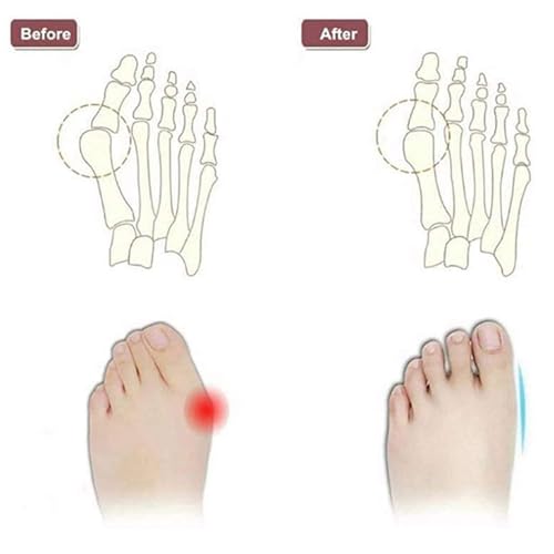 Casual Foot Correction Flat Sandals Men, Men's Summer Comfy Breathable Adjustable Bunion Corrector Sandals, Non-slip Beach Walking Shoes with Orthopedic Toe Ring, Heartwarming Ideas2