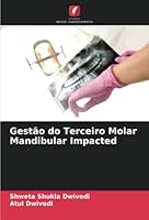 Gestão do Terceiro Molar Mandibular Impacted 6205281570 Book Cover