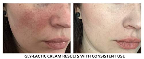 Planet Eden GLYLACTIC_LOTION 20% Gly-Lactic Face And Body Skin Cream Lotion - 10% Glycolic And 10% Lactic Acid thumb #3