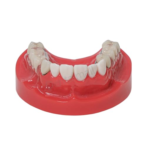 Dental Overdenture Typodont Model Lower Jaw Representing Telescope Crown M6010