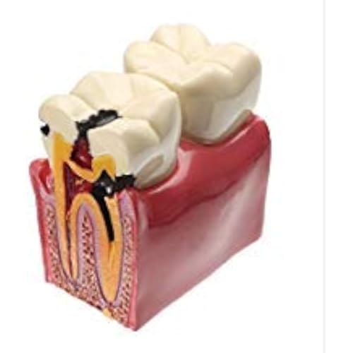 Dental Caries Tooth Model, YOUYA DENTAL 6 Times Caries Tooth Model Dental Anatomy Education Tooth Model Decay Teeth Comparative Study Model Teaching Typodont Model for Dentists Student Education
