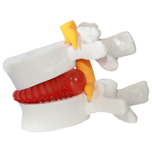 Modèle colonne lombaire 1,5 fois pour expliquer la hernie discale aux patients