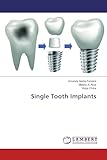 Single Tooth Implants