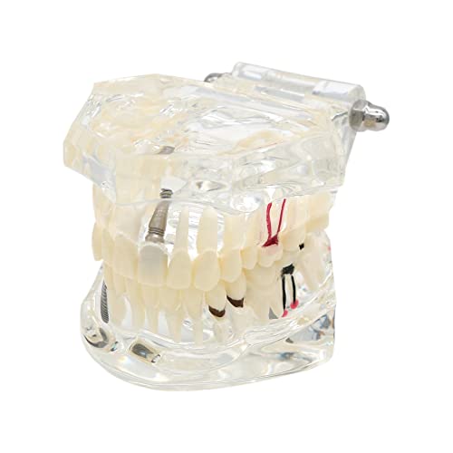 Dentalmall Dental Oral Typodont Model Implant Pathological Removable Teach Demo Visible Anatomy Demonstration Teaching Standard Size (Clear) #TOP2
