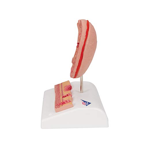 Image of 3B Scientific K17 Stomach w / Ulcers - 3B Smart Anatomy