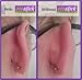 Otostick - FIVE PACK'S- Instant Correction for Prominent Ears - Best Alternative Short of Surgery by Otostick