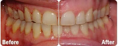 Miniatura 5 de ProBiora - Tabletas probióticas masticables para cuidado bucal Suplemento probiótico para mujeres y hombres Dientes y encías más saludables