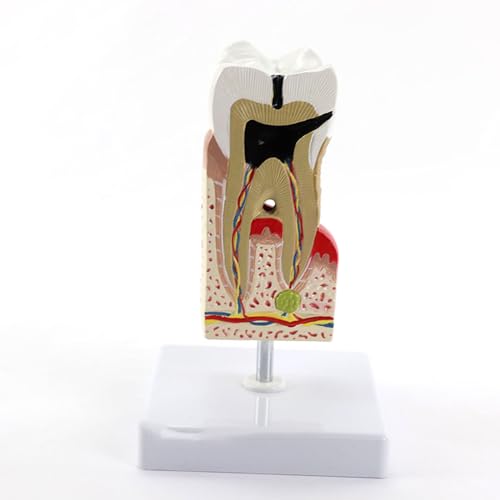 Modello ingrandito di Cura dei Denti Umani Carie Dentale Forniture mediche per Studenti Risorse didattiche Modello anatomico