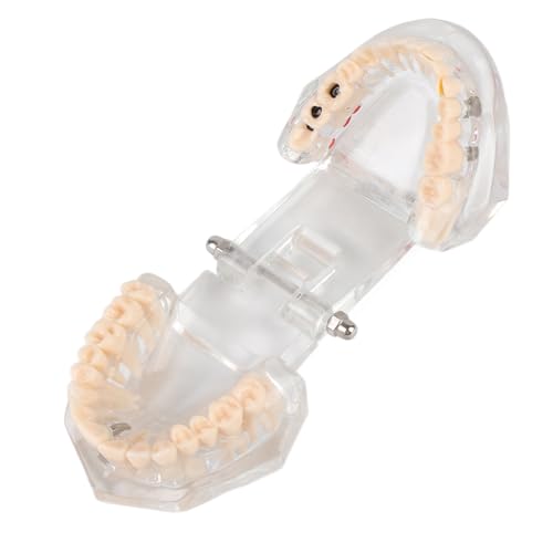 Natudeco Zahnmodell Dentalmodell Zahnkrankheits-Lehrmodell transparent, Demonstrationszahnmodell Zähneputzen, Zahnseide orales pathologisches Modell für den Schulunterricht, Forschung