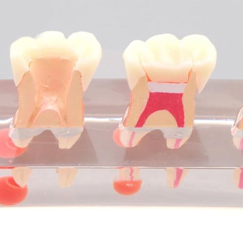 Modèle d'enseignement dentaire Sanfly pour expliquer le traitement endodontique complexe - 8