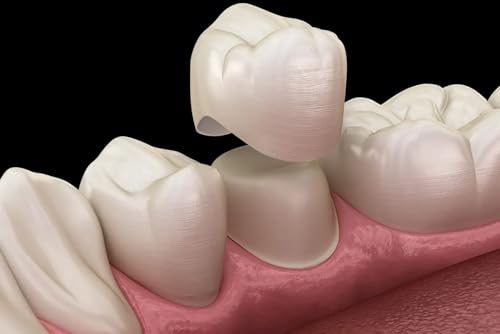 Dental Crown Advances in Modern Restorative Dentistry