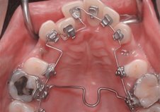 Lingual Orthodontics: The Truly Invisible Orthodontics