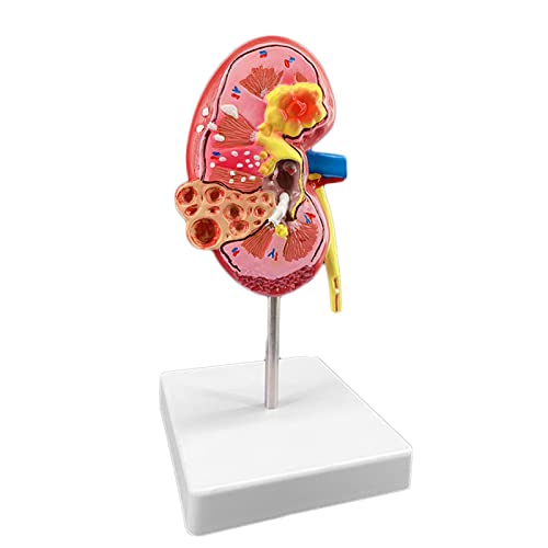 LBYLYH Modelo De Enfermedad De Cálculos Renales, Modelo Anatómico De Glomérulo Renal De Nefrona Renal, Modelo De Anatomía Renal, Suministro De Enseñanza Médica Cover