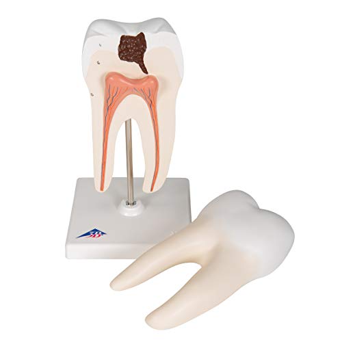 Image of 3B Scientific D10 /4 Lower Twin-Root Molar Showing Cavaties 2-part - 3B Smart Anatomy