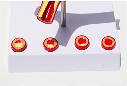 Anatomie Model, Educatief Model Anatomie Atherosclerose Model Trombus Trombose Vasculair Model Arterieel Bloedvat… - Image 5