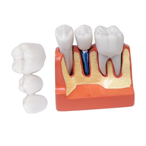 Design magnetico innovativo: questo modello di odontoiatria orale integra in modo intelligente un piccolo magnete nella connessione della corona, che aumenta la stabilità durante la dimostrazione e l'esposizione, rendendolo uno strumento didattico ideale per modelli di odontoiatria orale dettagliati.