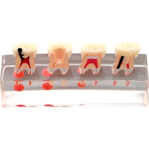 Modèle d'enseignement dentaire Sanfly pour expliquer le traitement endodontique complexe - 2