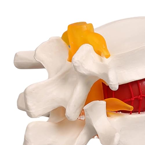 Image of Human Anatomical Lumbar Disc Herniation Model,1.5 Times Life Size Portable Lumbar Vertebrae Model ，Anatomy Medicine Teaching Tool for Medical Learning and Scientific Presentations