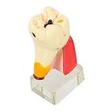 MAGICLULU Zahnmodell Karies Zahnerkrankungen Anatomisches Lehrmodell für Ausbildung und Patientenaufklärung