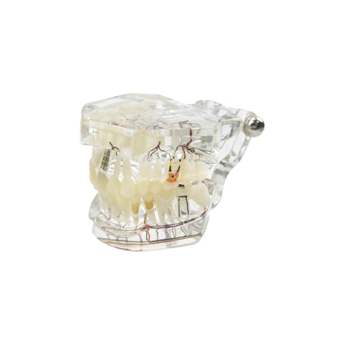 YOUYA DENTAL Modèle dentaire de réparation neurale - Modèle dentaire - Modèle d'implant - Modèle dentaire standard - Modèle d'enseignement des dents pathologiques amovibles pour les dentistes – vue 6