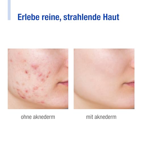 Aknederm Creme H 30g - mattierende Gesichtscreme kaschiert Pickel & Rötungen -getönte Feuchtigkeitscreme ideal für zu Akne neigende Haut & Pickel - talgregulierende Tagescreme ohne Parfüm