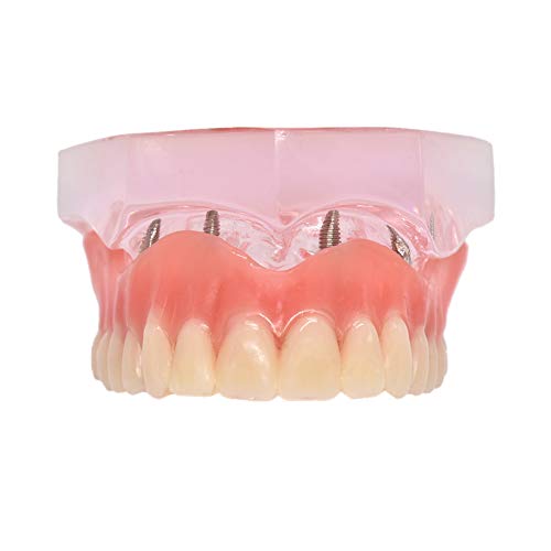 Oral Dentistry 歯科インプラントモデル 上顎模型 歯列模型 研究用 治療説明用 4本釘 取り外し可能 クリアベース 透明
