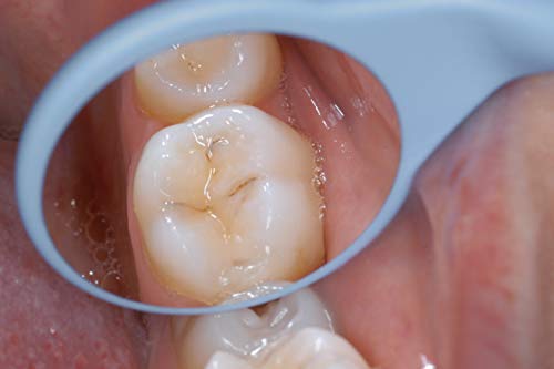 Dentosmile Dental Hahnenkratt Relax FS Rhodium Mouth Mirrors Size No. 5 Pack of 10 Pcs