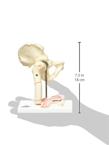 3B Scientific A88 Femoral Fracture and Hip Osteoarthritis + free Anatomy App - 3B Smart Anatomy - Image 4
