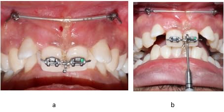 Miniatura 3 de Sino Dental Orthodontic Brackets Dontrix Force Gauge Dynamometro, marca grabada en negro, mide hasta 14.11 oz, hecho de acero inoxidable