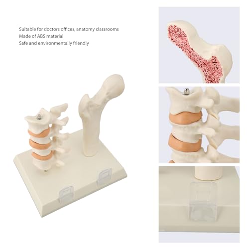 Image of ZJchao Osteoporosis Spine Model, ABS Anatomical Osteoporosis Model, Pathological Changes Visualization Versatile Learning Tool for Anatomy Education Constructed