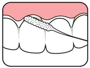 Tepe Bridge & Implant Floss