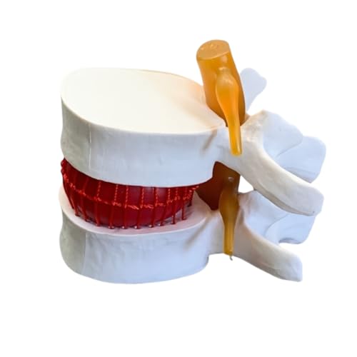 Image of Herniated Disc Spine Model, 1.5X Life Size Lumbar Spine Anatomy Model for Teaching, Chiropractic Demonstration, Medical Learning and Patient Education (1pc Spine and Disc Model)
