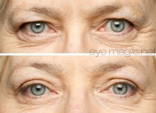 Eye Magic Original Eye Lift Kit (Small/Medium Size With Gel) Lifts Eyelid Droop and Hooded Eyes | Open And Show Off Your Beautiful Eyes | Made In America