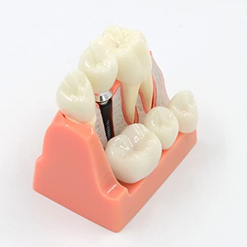 Modèle d'implant 4 fois avec structures anatomiques pour enseignement
