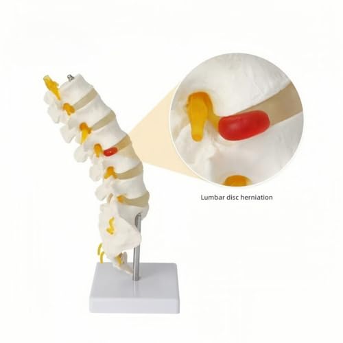 Image of Human Anatomical Lumbar Disc Herniation Model Life Size Lumbar Spine Model for Teaching and Learning (Spine-Tall)