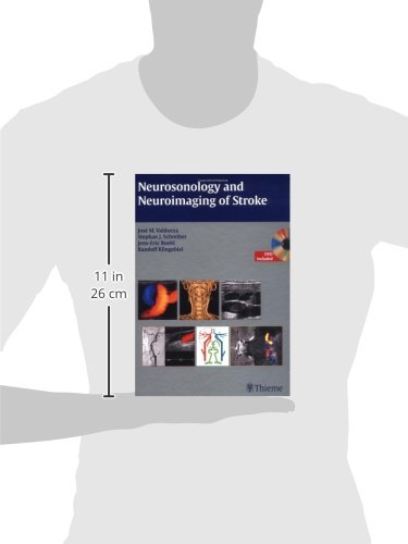 Neurosonology and Neuroimaging of Stroke: A Teaching Atlas