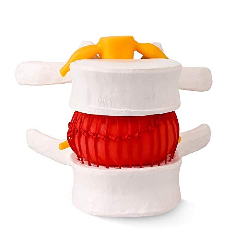 Image of Premium ✮ Lumbar Disc Herniation Model ✮ Lumbar Spine Model for Teaching & Learning ✮ Excellent Way for Demonstrating Herniated Lumbar Disc