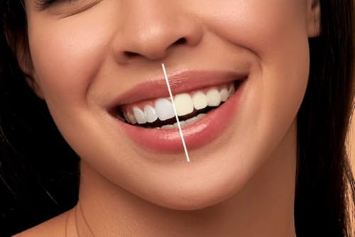 Teeth Whitening and Sensitivity: How to Protect Enamel